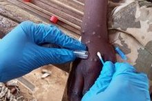 Mpox en Afrique : les enfants particulièrement menacés par la nouvelle variante
