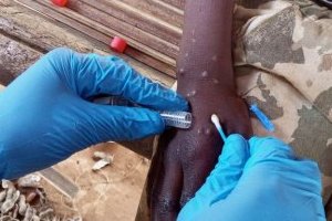 Mpox en Afrique : les enfants particulièrement menacés par la nouvelle variante
