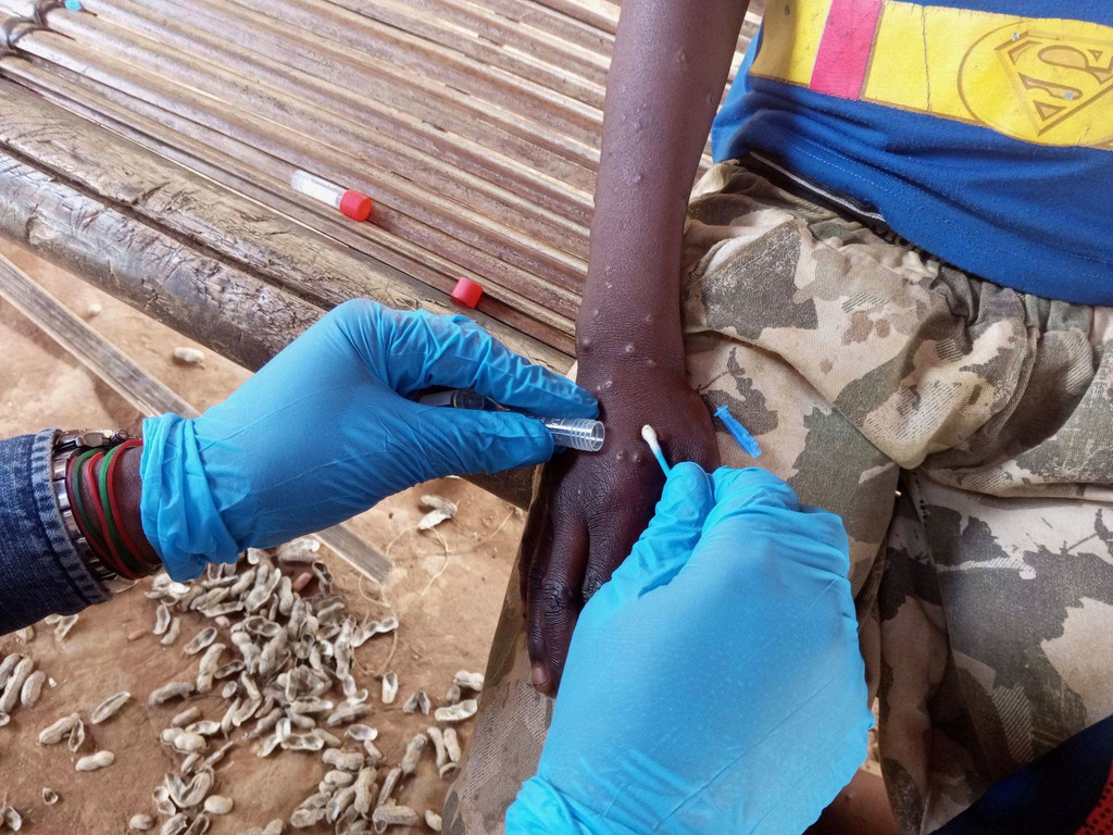 Mpox en Afrique : les enfants particulièrement menacés par la nouvelle variante
