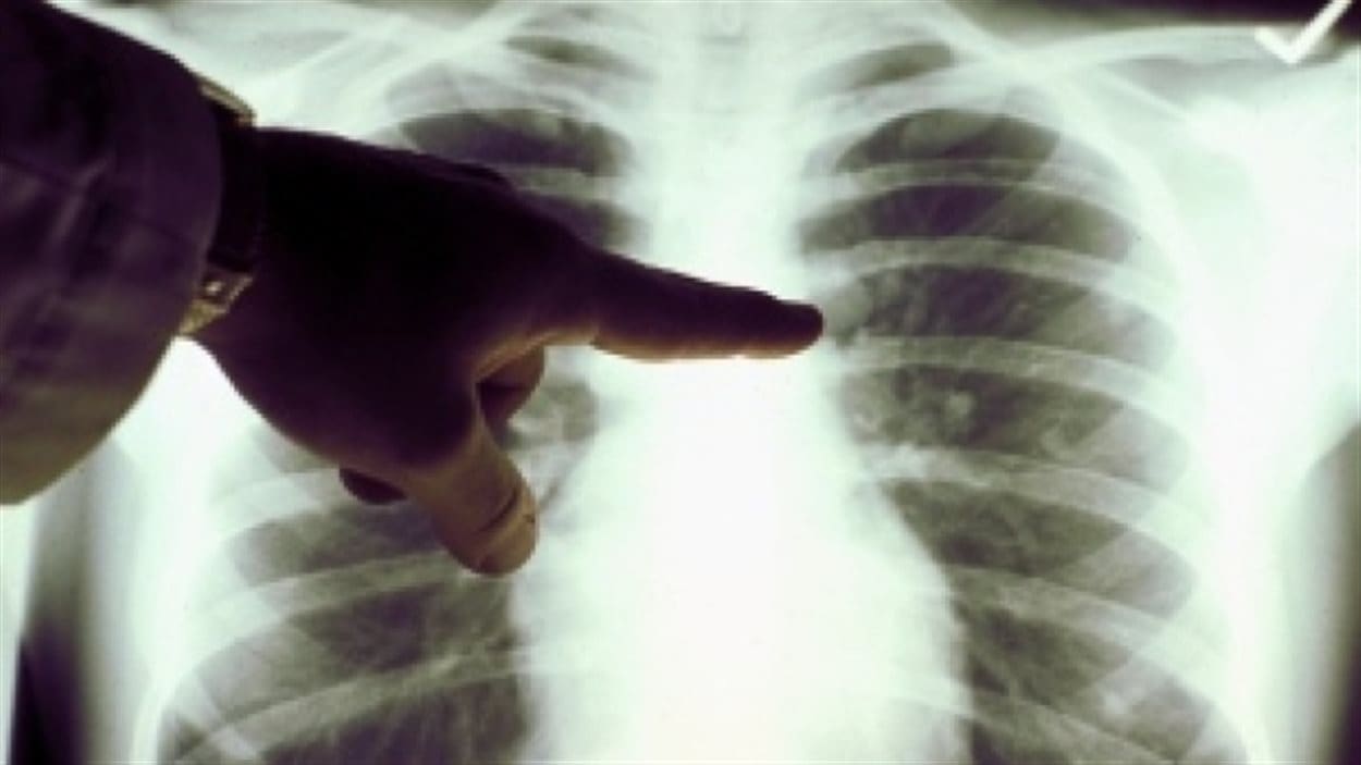 Tuberculose : 1,4 million de malades privés des soins nécessaires pendant la première année de la Covid-19

